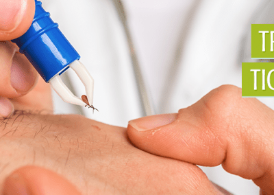 Treating Tick Bites