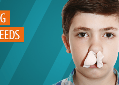 Treating Nosebleeds